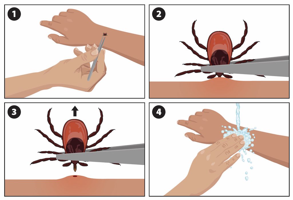 clipart style image showing the proper removal of a tick using a pair of tweezers