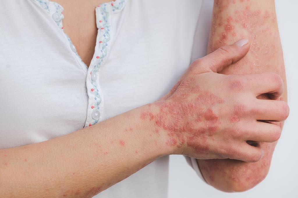 7 Non-prescription Products That Can Relieve Psoriasis Symptoms