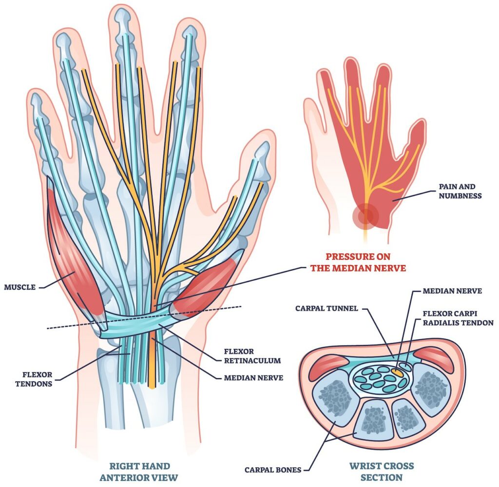 https://depositphotos.com/vector/carpal-tunnel-syndrome-median-nerve-pressure-disease-outline-diagram-labeled-574182564.html